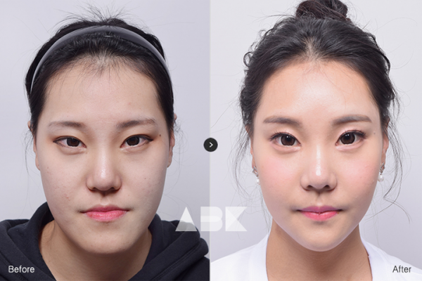 정소희_전후_01