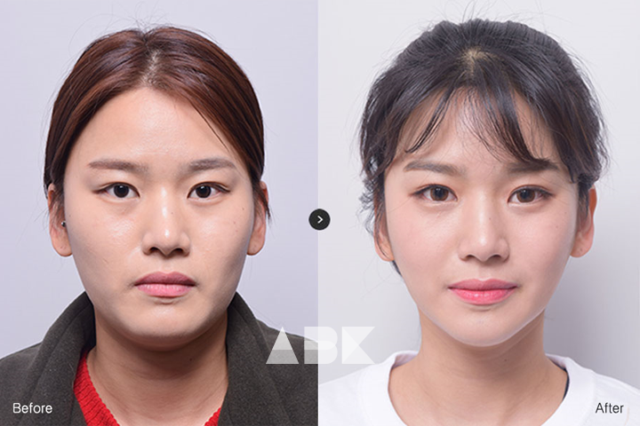 김세하_전후_01