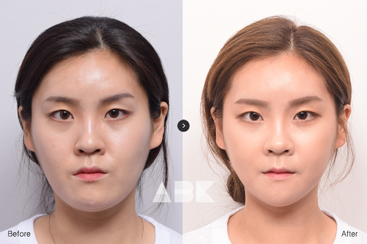 구지은_전후_01