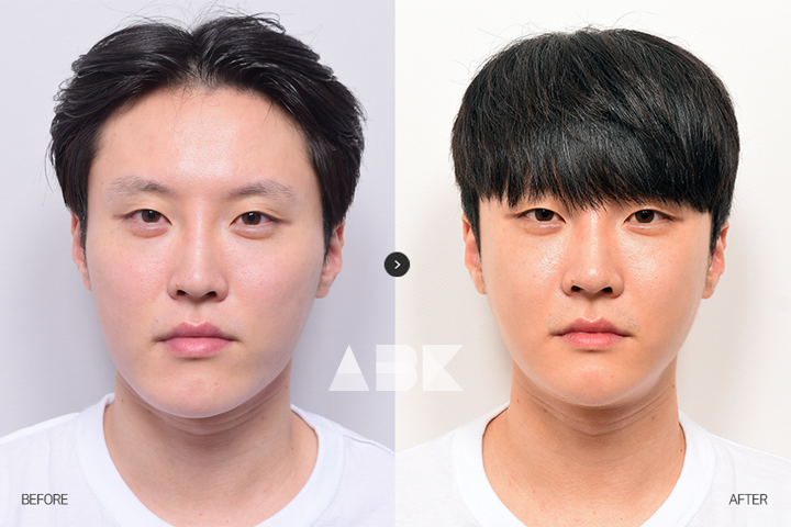 강영민_전후_01