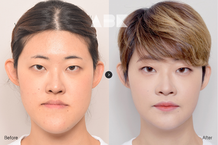 한지현_전후_01