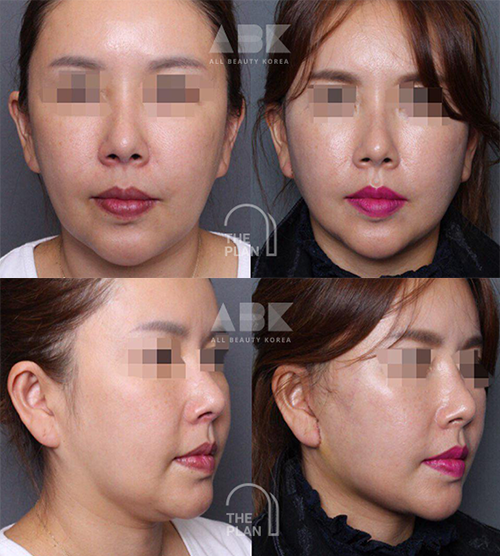 ザ·プラン美容整形外科を通じて切開リフトを受けた多くの方々の事例写真_7
