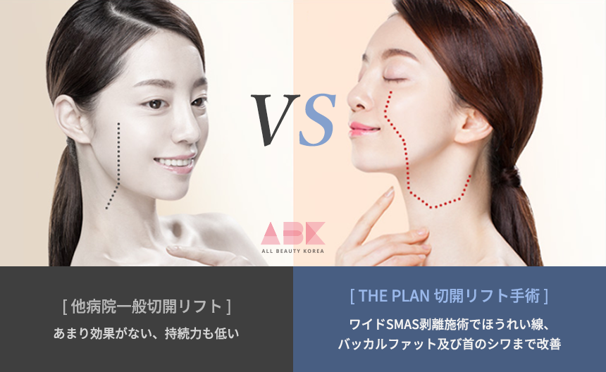 ザ·プラン美容整形外科が持つ切開リフトの差別化_2