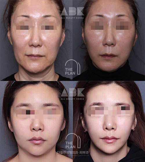 ザ·プラン美容整形外科を通じて切開リフトを受けた多くの方々の事例写真_8