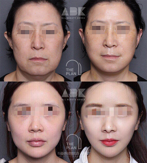 ザ·プラン美容整形外科を通じて切開リフトを受けた多くの方々の事例写真_9