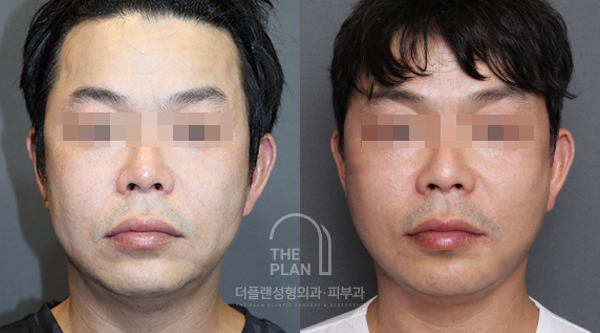 더플랜_전후02