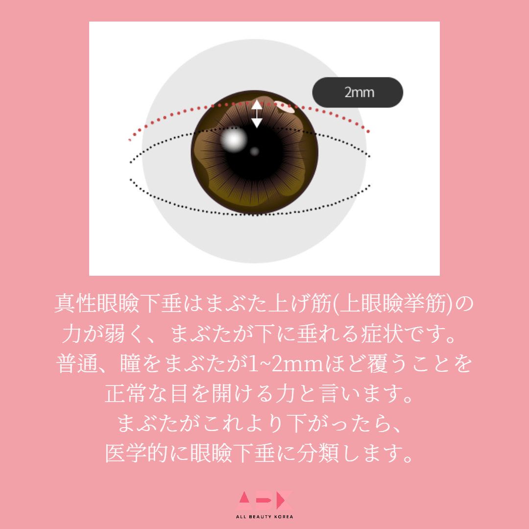 眼瞼下垂、韓国目整形