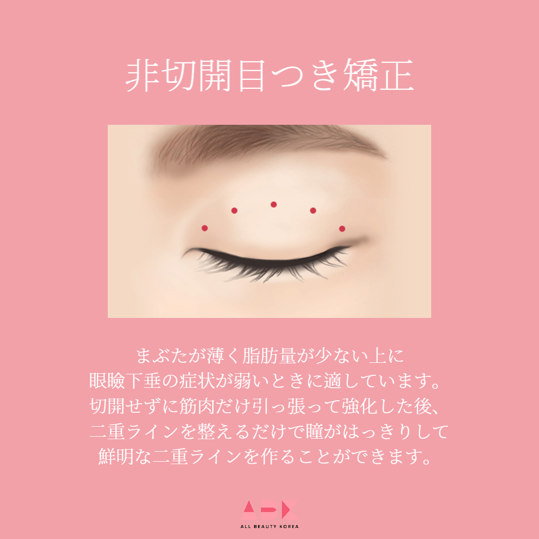 切開目つき矯正