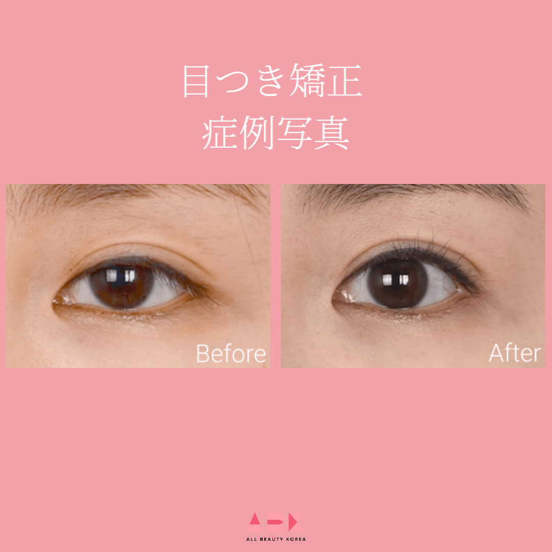 眼瞼下垂症例写真