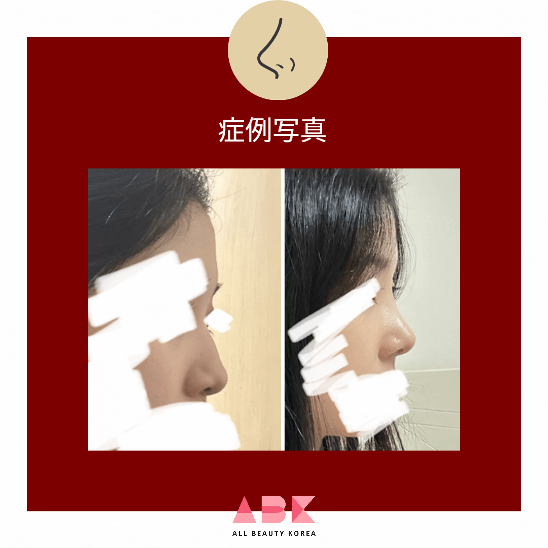 症例写真