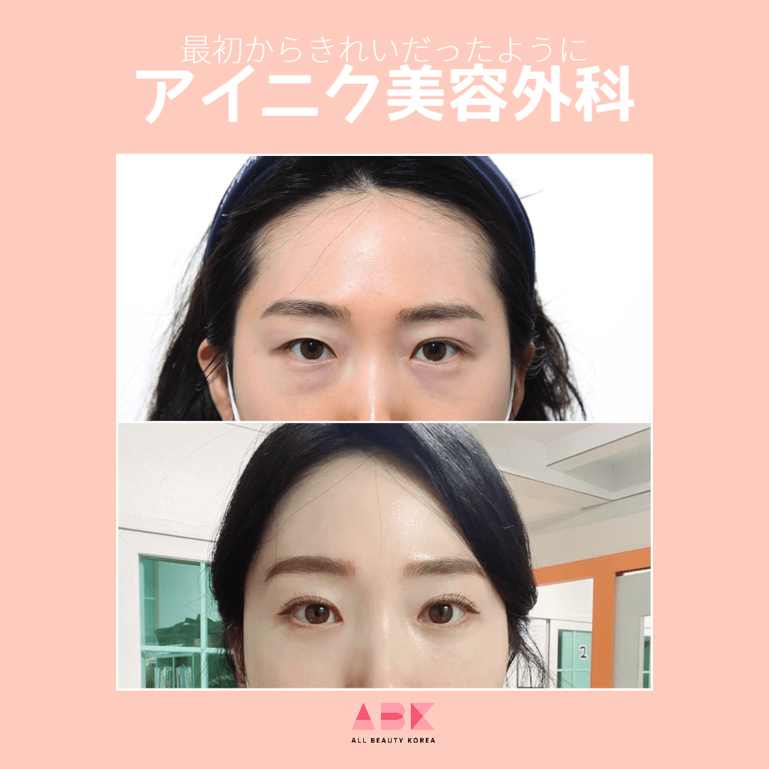 アイニク美容外科目整形 Before/After