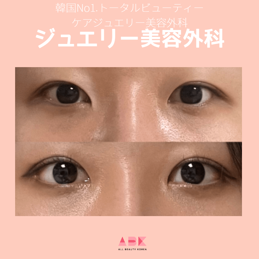ジュエリー美容外科目整形 Before/After