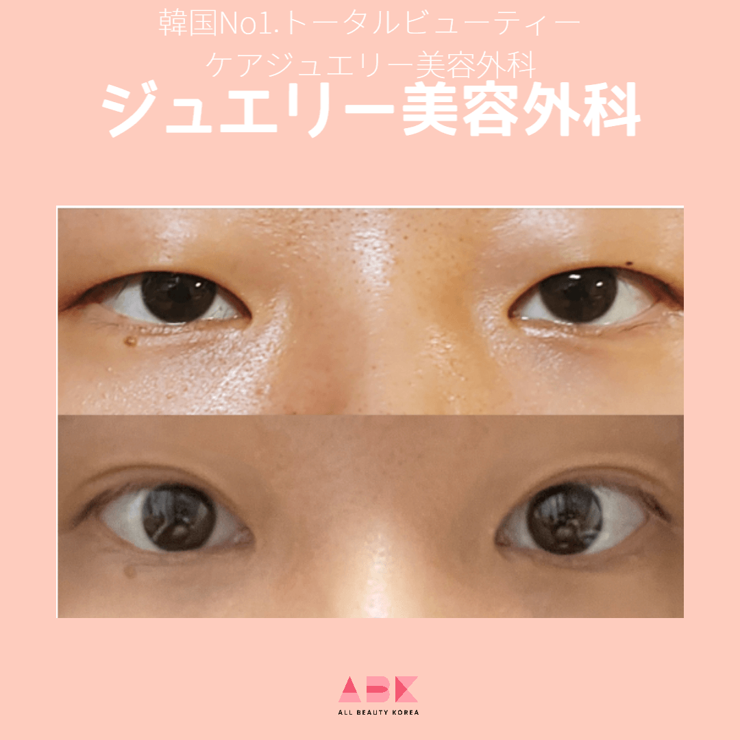 ジュエリー美容外科目整形 Before/After