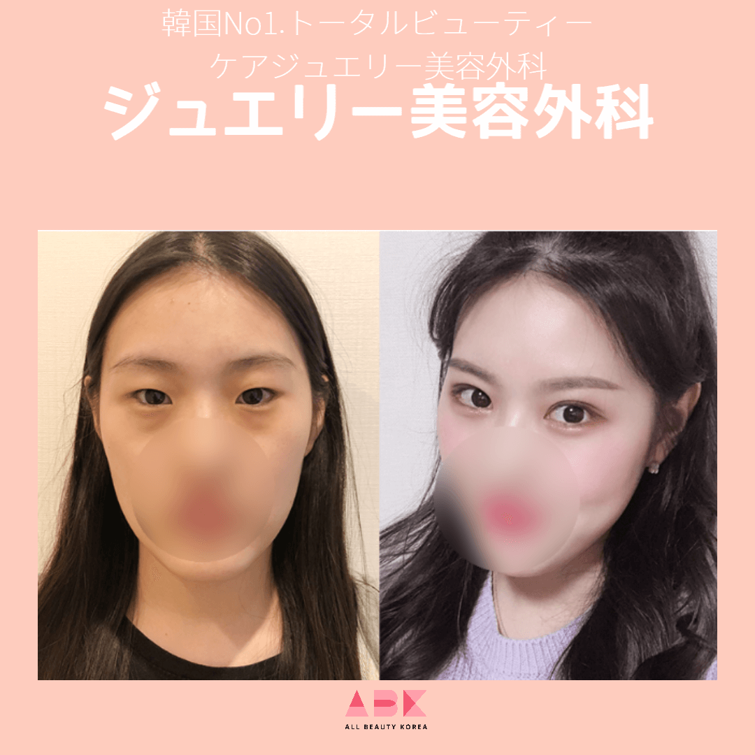 ジュエリー美容外科目整形 Before/After