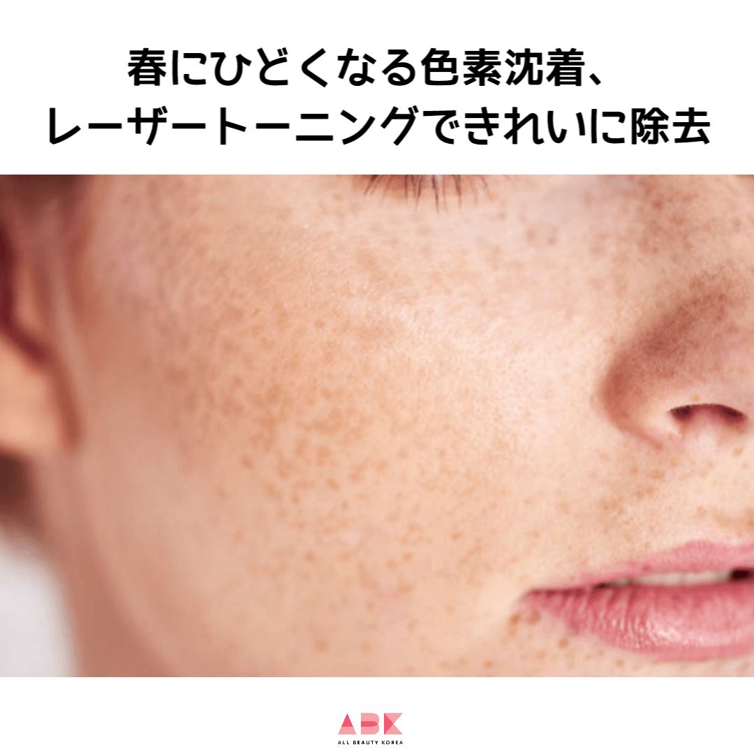 春にひどくなる色素沈着、レーザートーニングできれいに除去