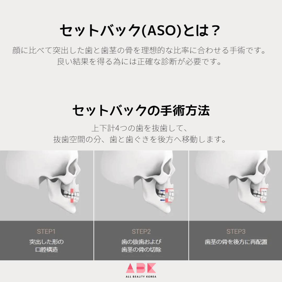 セットバック(ASO)とは?