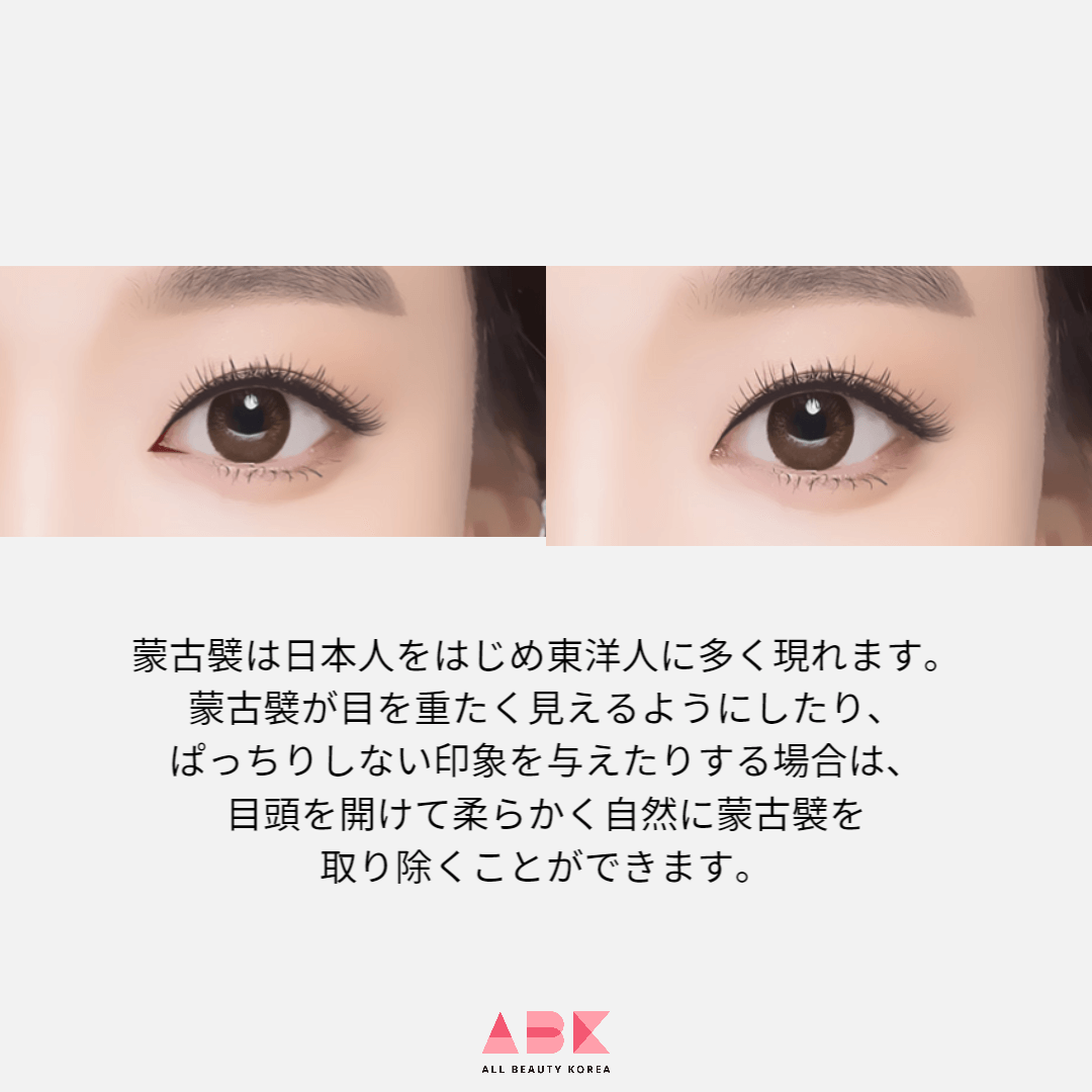 目の蒙古襞とは?切開法で目元をはっきり