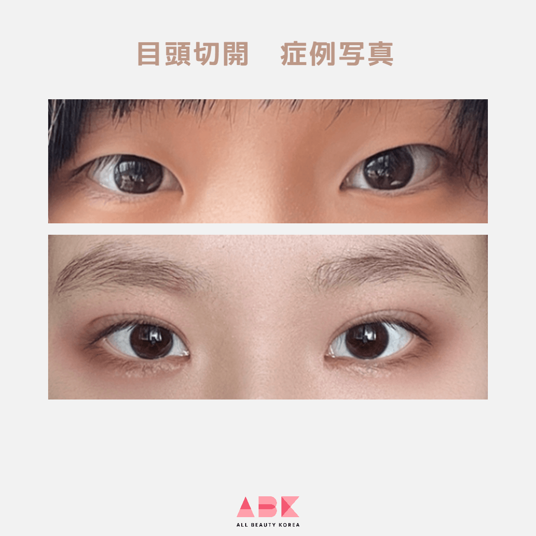 目の蒙古襞とは?切開法で目元をはっきり