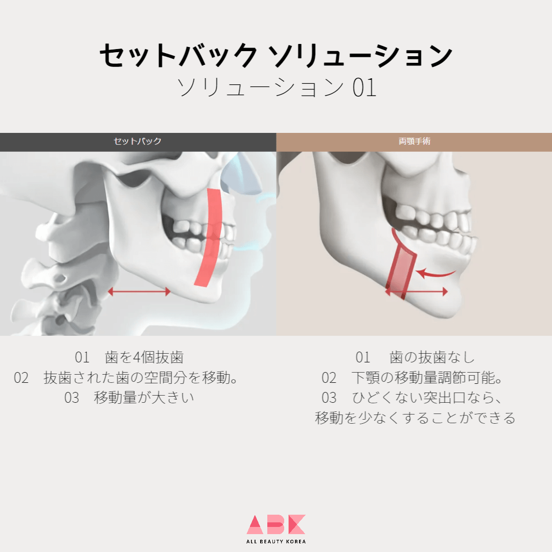 セットバックの際、個人によって異なる顔の比率を正確に診断することが重要
