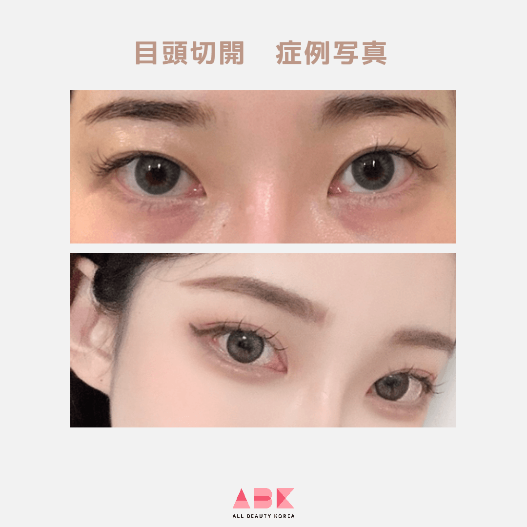 目の蒙古襞とは?切開法で目元をはっきり