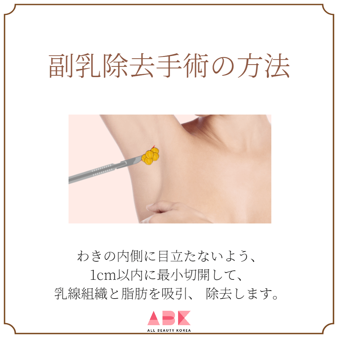 副乳除去手術の方法