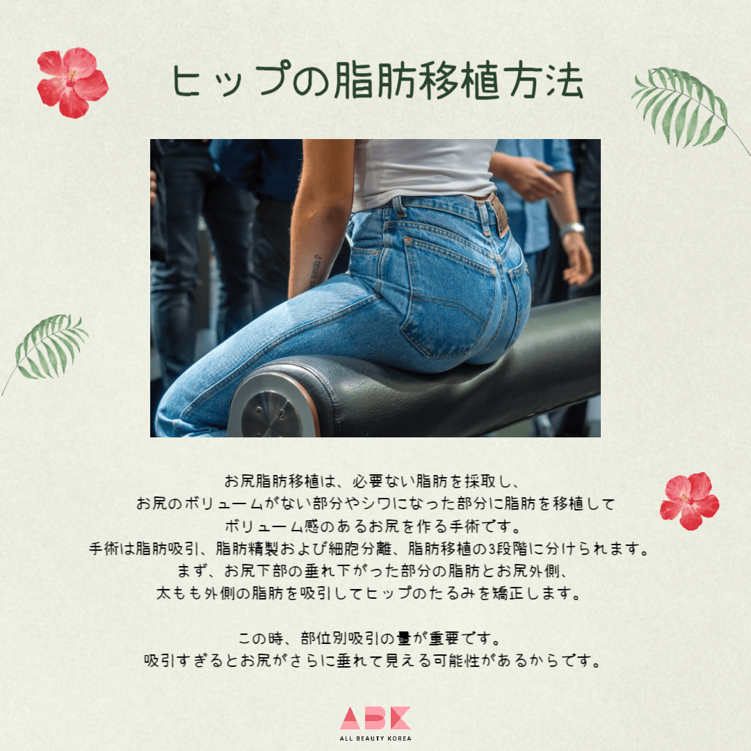 ヒップの脂肪移植方法