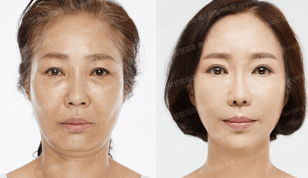 쥬얼리 리프팅 01