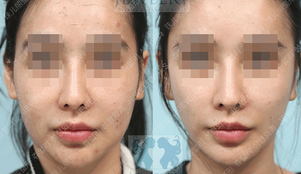 쥬얼리 리프팅 02
