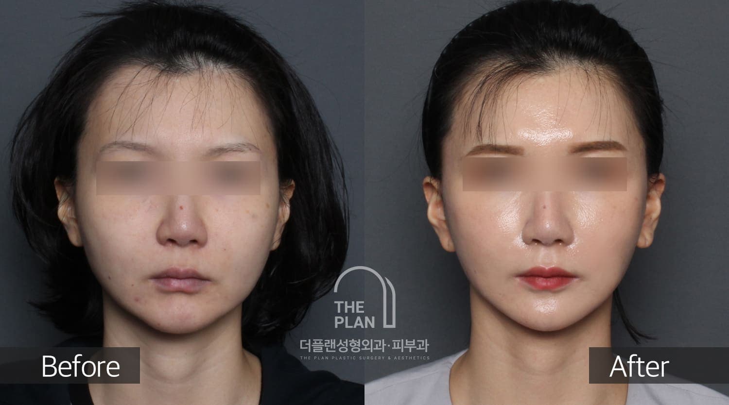 공류현-FL-LS앞볼-Jowl1