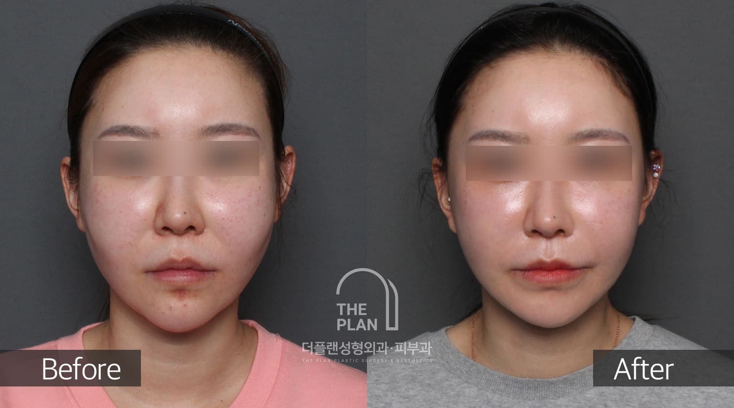 곽세미-MN-FL-LS앞볼-Jowl-필러녹이기턱끝1