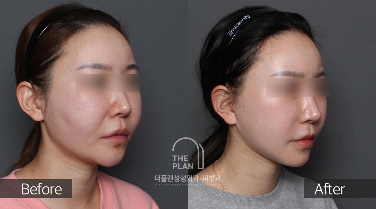 곽세미-MN-FL-LS앞볼-Jowl-필러녹이기턱끝2
