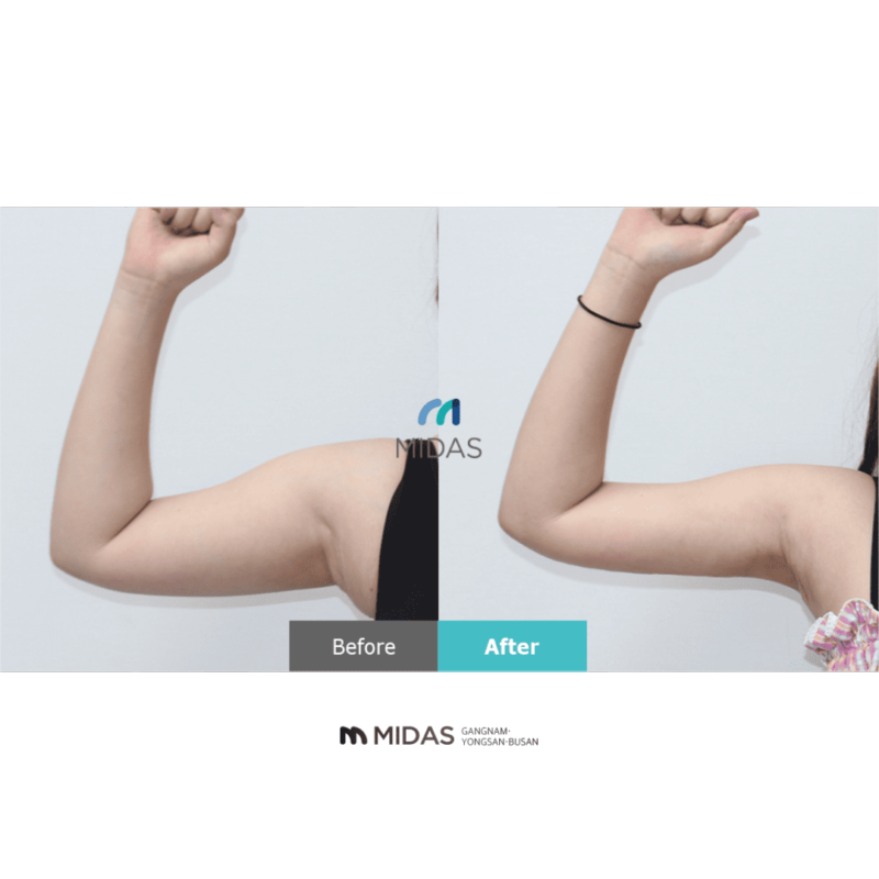 この画像は、MIDAS医療クリニックのビフォーアフター写真を示しています。上腕の筋肉が明らかに引き締まっているのがわかります。このサービスは、患者の体型改善に効果的であることを示唆しています。医療サービスの提供にあたっては、患者の健康と安全を最優先にする必要があります。デザイン性や見栄えの追求だけでなく、医学的根拠に基づいた適切なケアが重要だと考えられます。