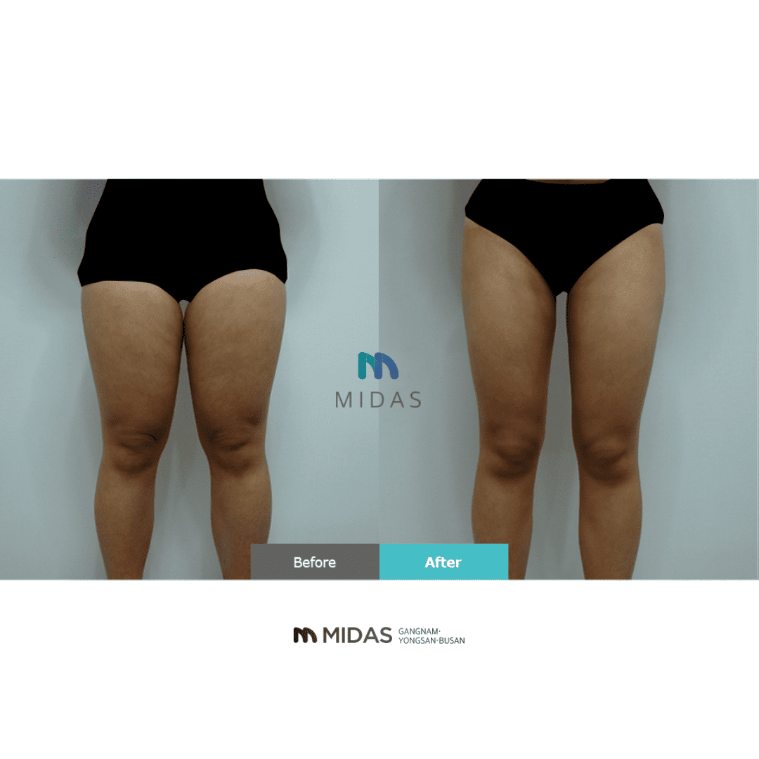 はい、この画像はMIDASクリニックのビフォーアフター写真を示しています。患者の体型改善の効果が明らかにわかりますね。このような医療サービスを提供する際は、医学的根拠に基づいた適切なケアが重要だと考えられます。患者の健康と安全が何より優先されるべきでしょう。