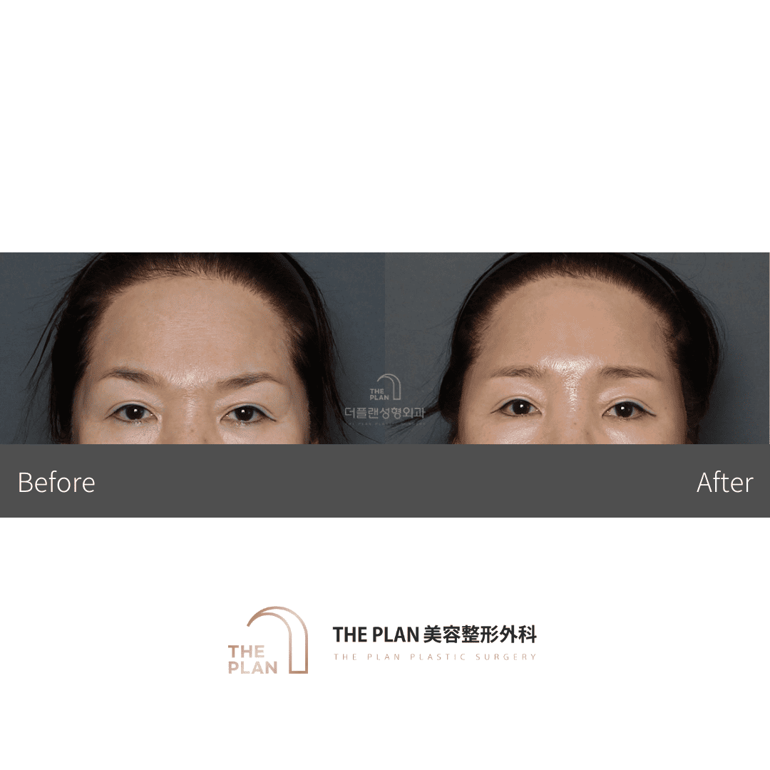 画像は整形手術前後の顔の変化を示しています。顔の輪郭や目、鼻の特徴が変化しているのがわかります。美容整形外科のサービスを紹介しているようです。