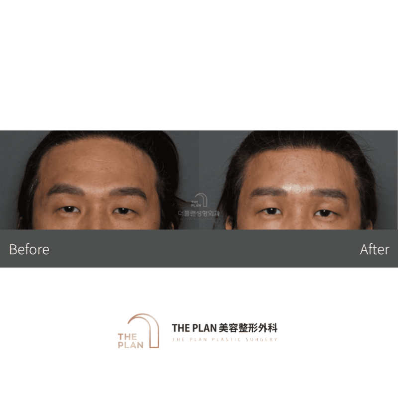 画像では、整形手術前後の顔の変化が示されています。顔の輪郭や目、鼻の特徴が変化しているのがわかります。美容整形外科のサービスを紹介しているようです。