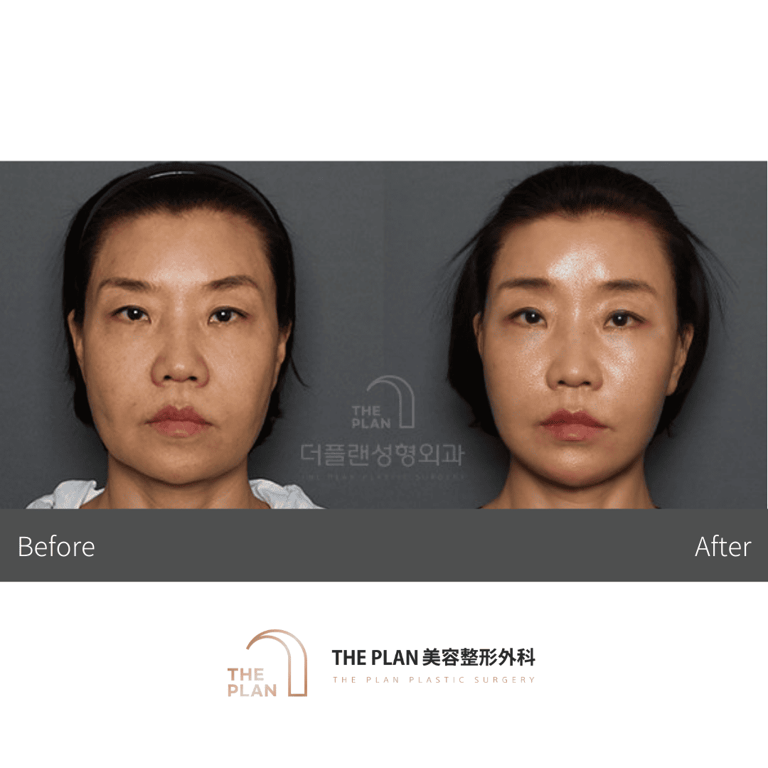 この画像は整形手術前後の顔の変化を比較しています。顔の輪郭や特徴が変化しているのがわかります。美容整形外科のサービスを紹介しているようです。