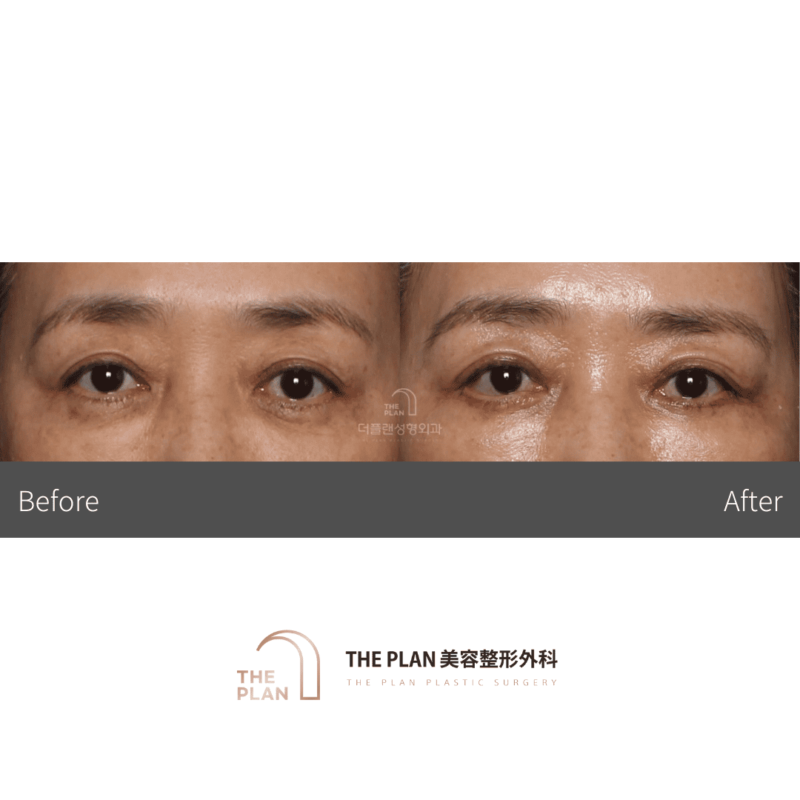 画像は before와 after の比較を示しています。前後の変化を見ることができます。人物の顔は明確に識別できませんが、美容整形手術の結果だと推測されます。この画像は美容整形外科のサービスを宣伝しているものだと考えられます。