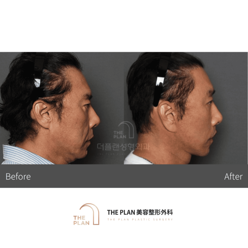 この画像では、整形手術前後の顔の変化が示されています。輪郭やその他の特徴が変化しているのがわかります。美容外科クリニックのサービスを紹介しているものと思われます。
