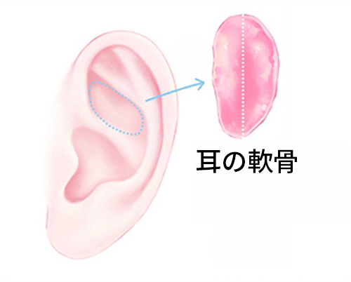 韓国の鼻整形で多く使用される耳の軟骨の図。