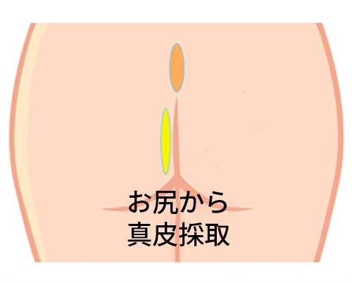 韓国の鼻整形で多く使用されるお尻の真皮の採取部分の場所を現した絵。
