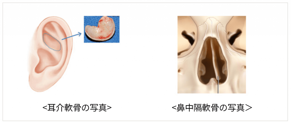 KOKO美容外科で使用している耳介軟骨と鼻中隔軟骨の画像