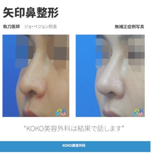 KOKO美容外科、韓国矢印鼻の手術方法・症例写真 | 矢印鼻 | 鼻整形 | 症例写真 | 韓国美容外科KOKO美容外科 | 韓国鼻整形専門美容外科