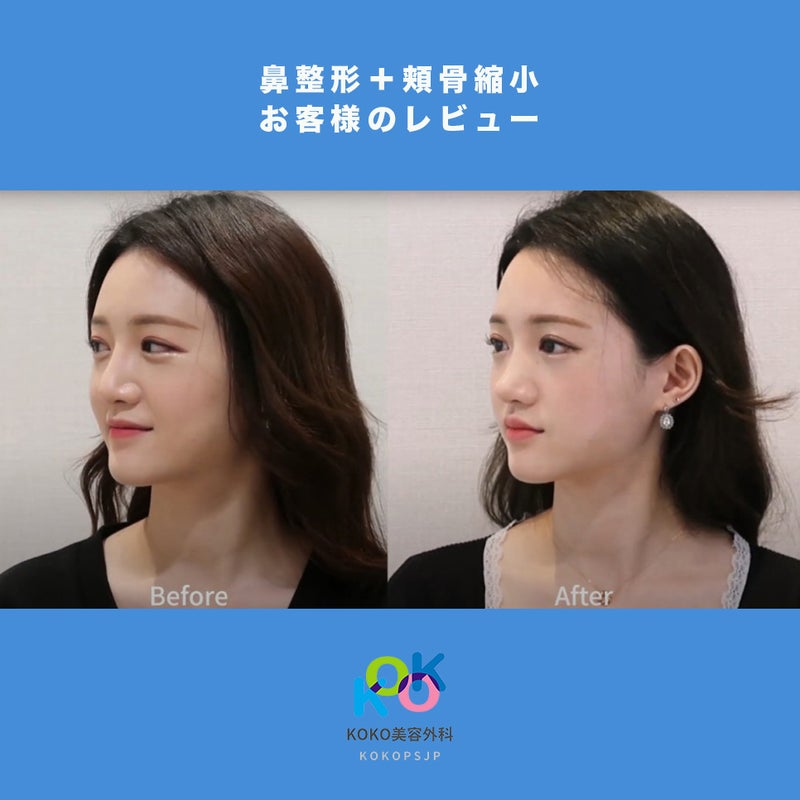 狎鴎亭KOKO美容外科の鼻手術&韓国頬骨縮小手術レビュー | 韓国頬骨縮小手術 | 鼻の整形 | KOKO美容外科 | 韓国鼻整形専門美容外科