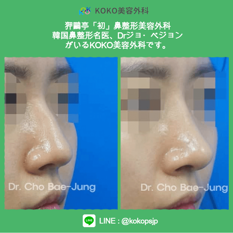 KOKO美容外科の症例写真8
