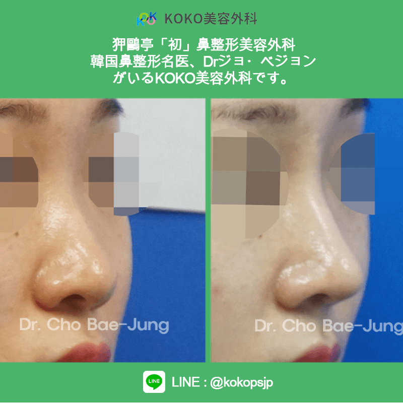 KOKO美容外科の症例写真７