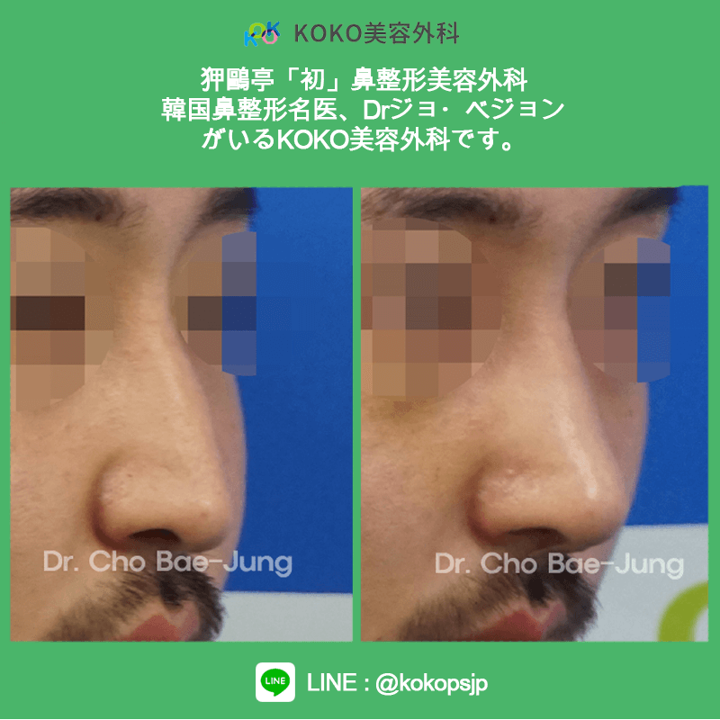 KOKO美容外科の症例写真６