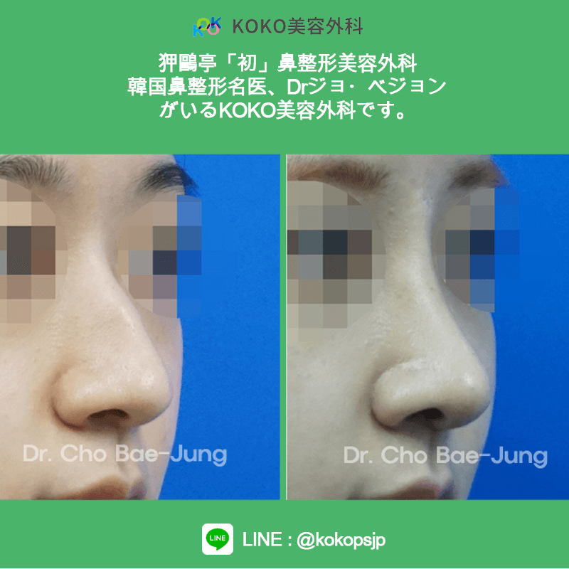 KOKO美容外科の症例写真５