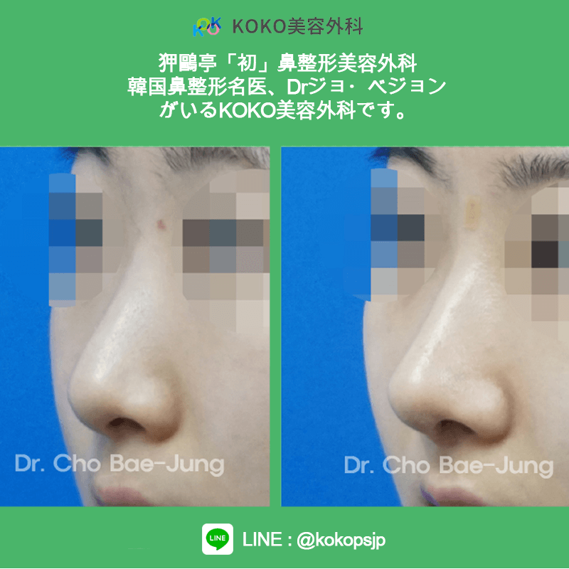 KOKO美容外科の症例写真４