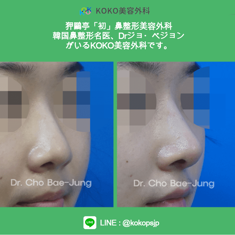 KOKO美容外科の症例写真３