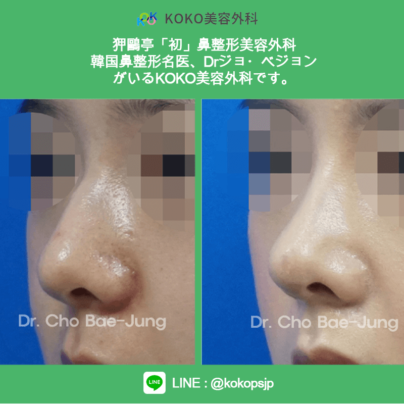 KOKO美容外科の症例写真２